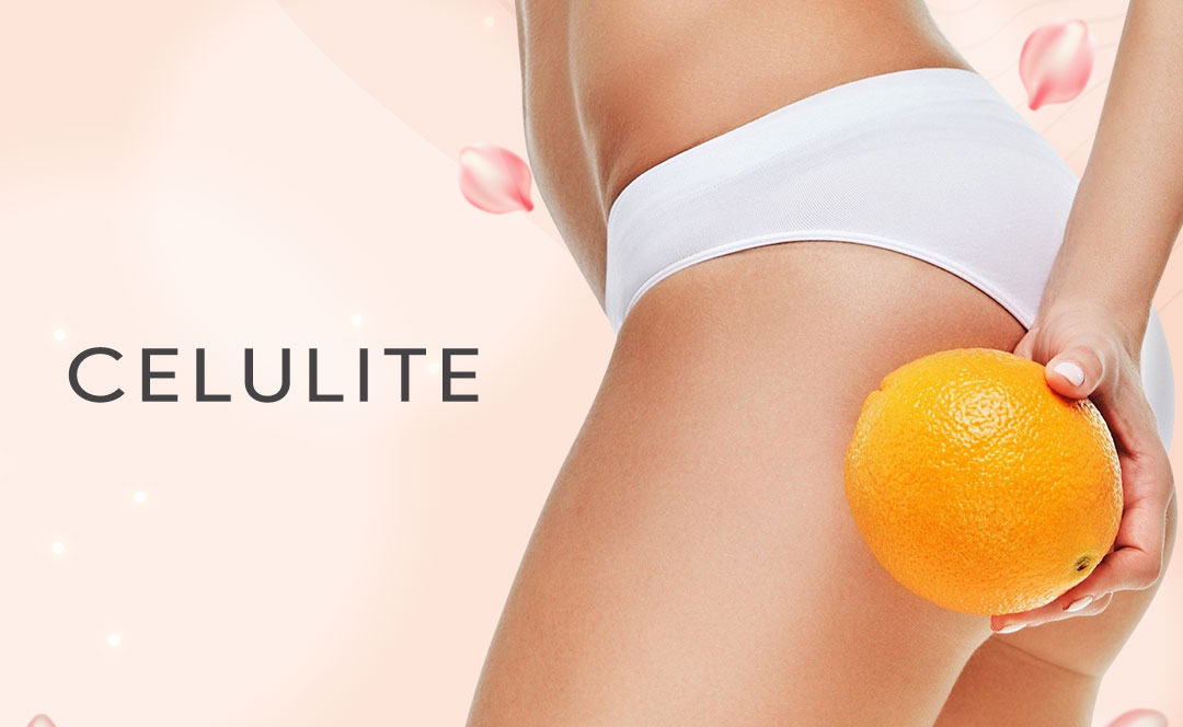 Celulite: Fatores e causas por trás da casca de laranja