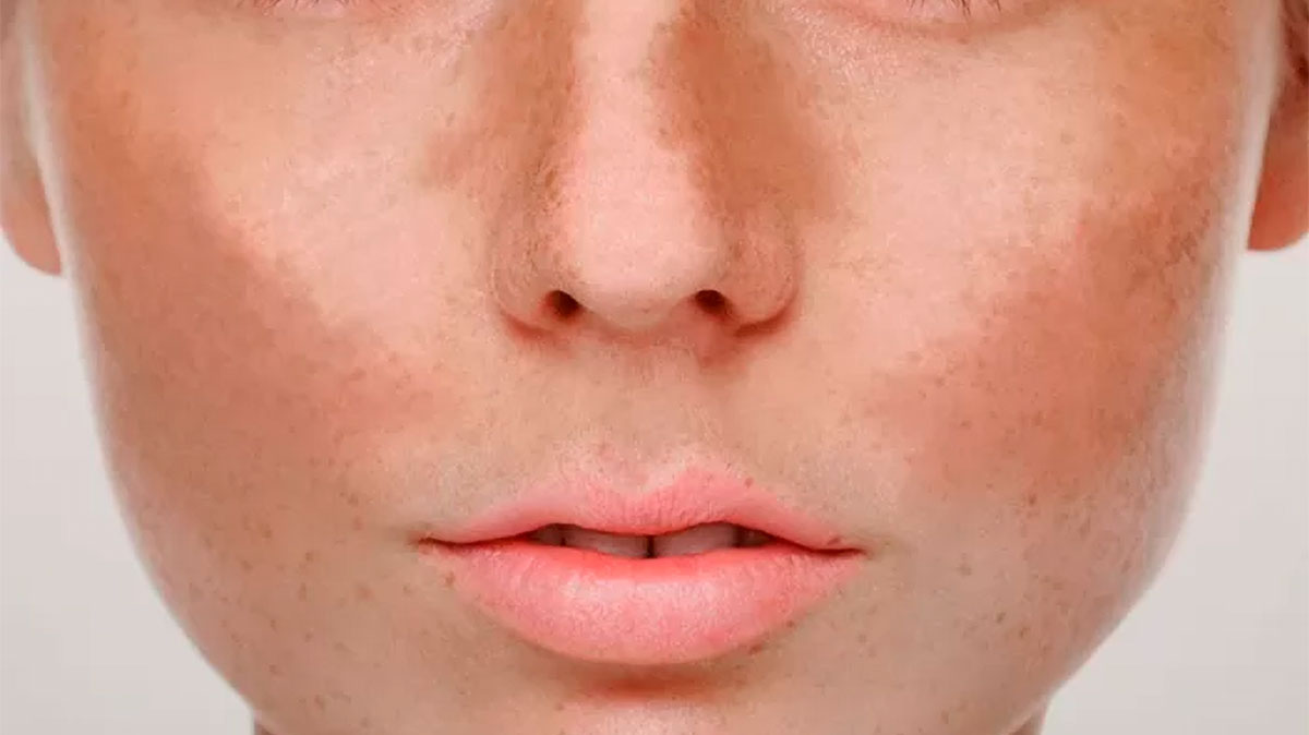 Melasma: causas, prevenção e tratamento